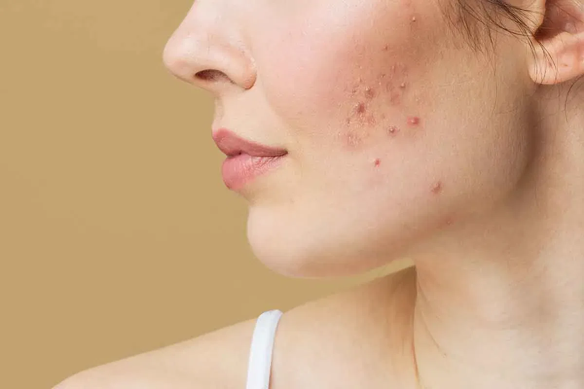 Bid Farewell to Textured Skin: All About the Best Acne Scar Treatment in Lake Town Kolkata