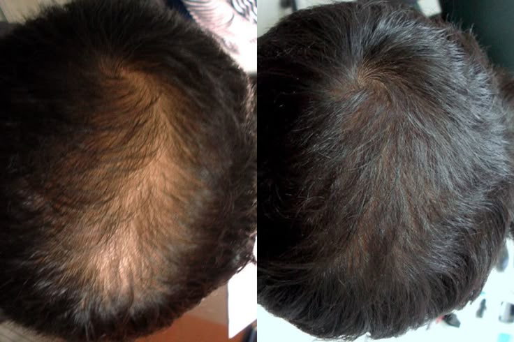 Doctor-led hair restoration treatment for natural, denser hair at Aluxe Aesthetics