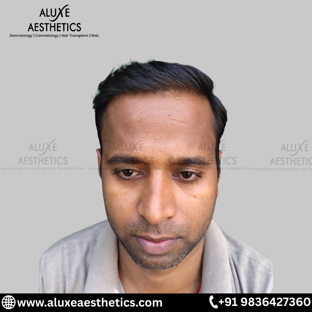 Hair Transplant after