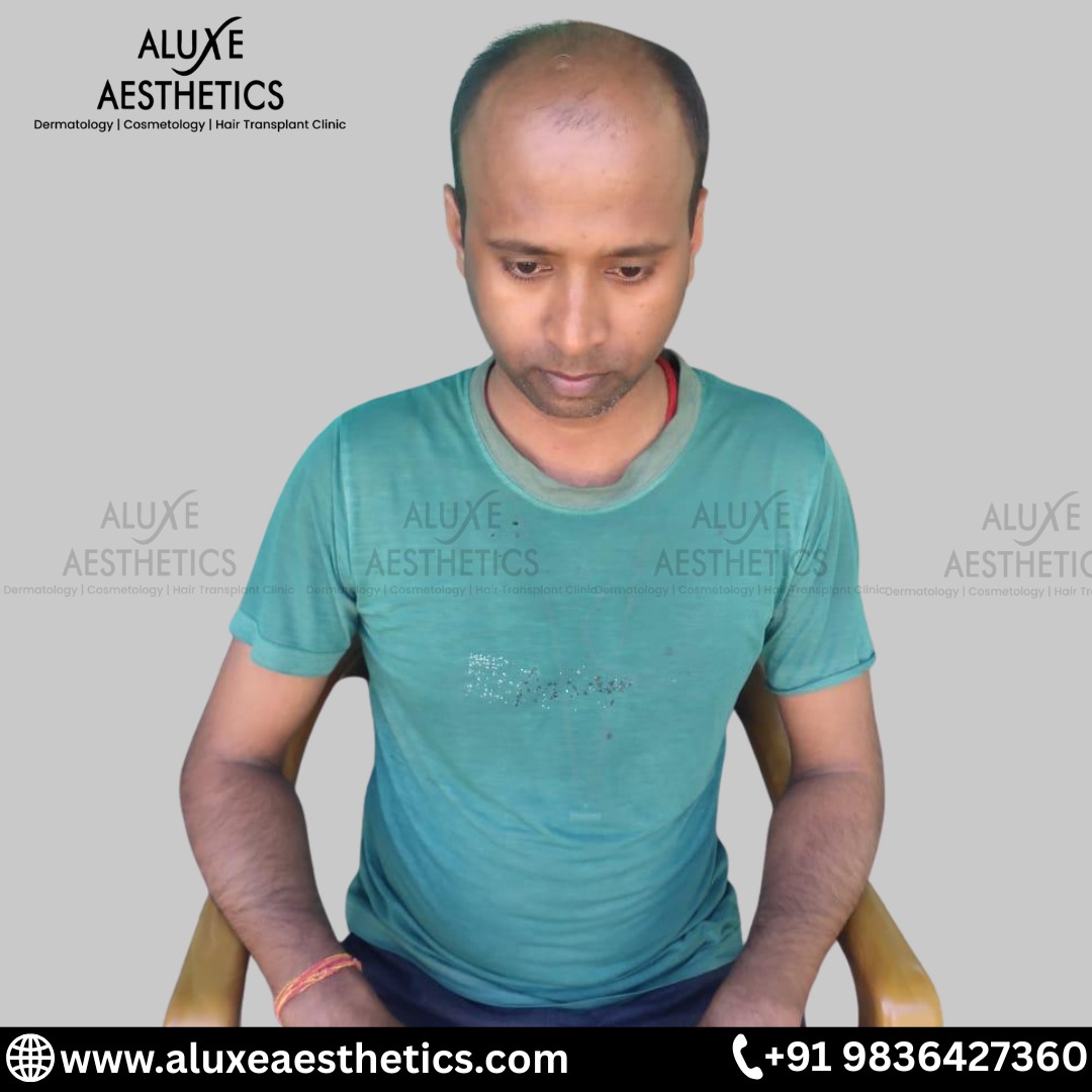 Hair Transplant before