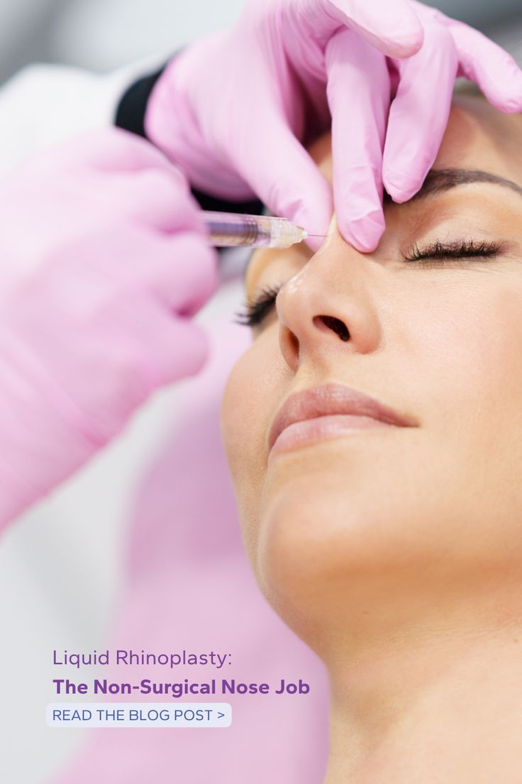 Liquid Rhinoplasty