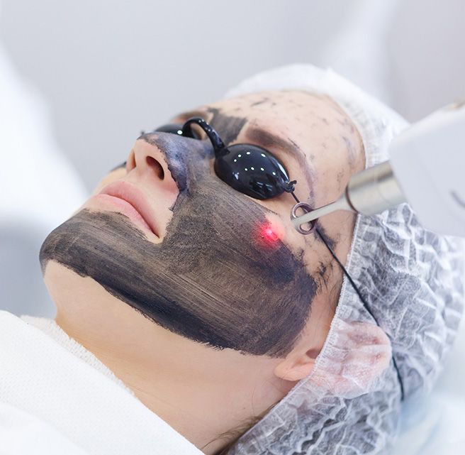 Carbon Laser Treatment