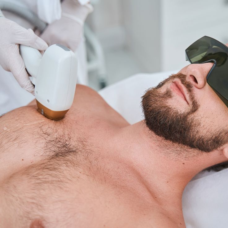 Laser hair removal