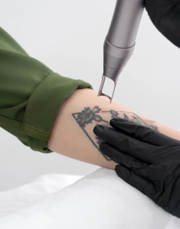 Laser Tattoo Removal