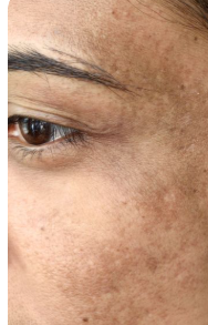 Melasma Treatment