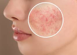Rosacea Treatment