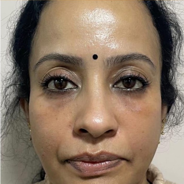 Under Eye Fillers after