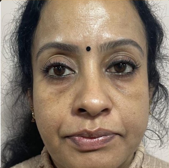 Under Eye Fillers before